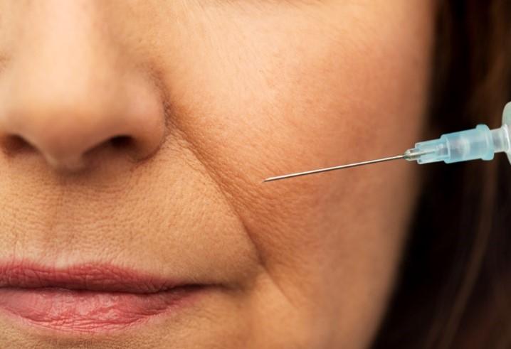 picture of woman receiving botox for nasolabial folds