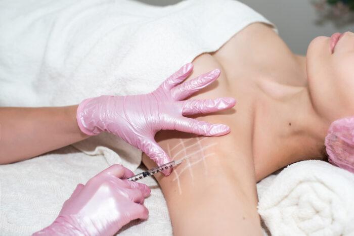picture of a woman having hyperhydrosis treatment on her armpits