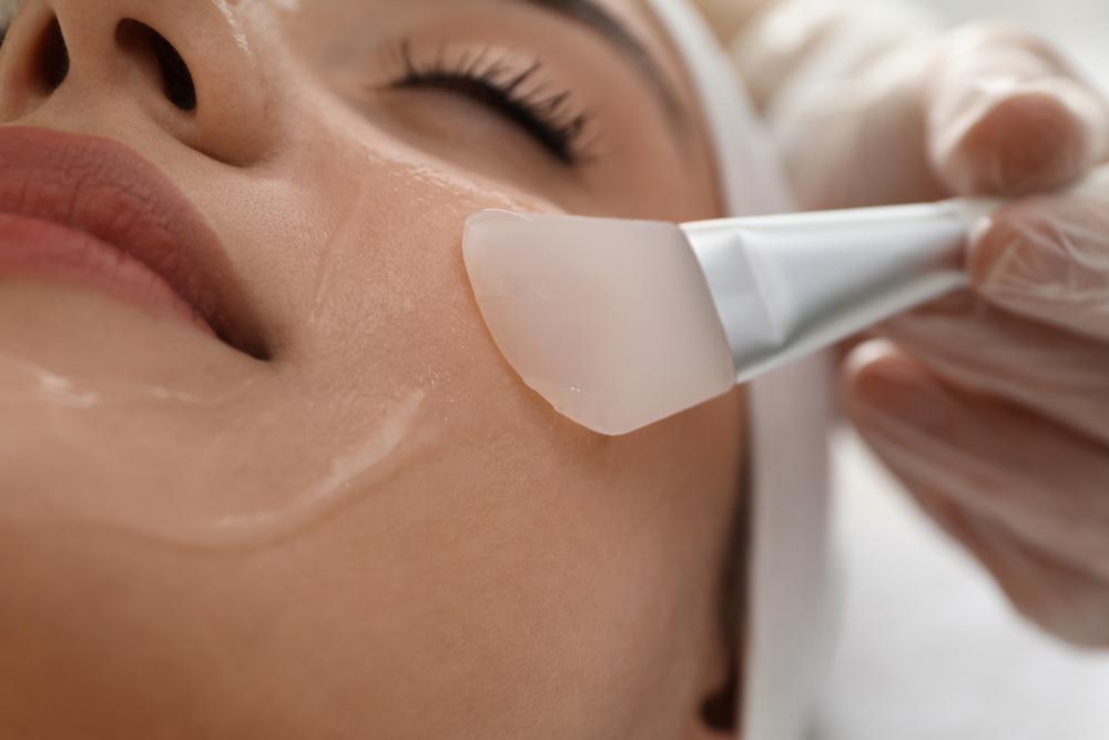 picture of woman receiving a chemical peel